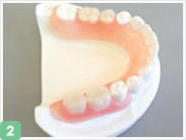 入れ歯の床を歯に固定