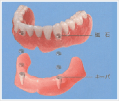 マグネット義歯