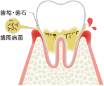 歯ぐきの炎症