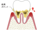 歯肉炎