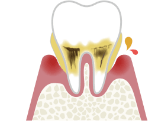歯ぐきの腫れ・膿 激しい痛み