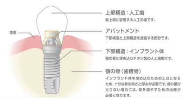 インプラント